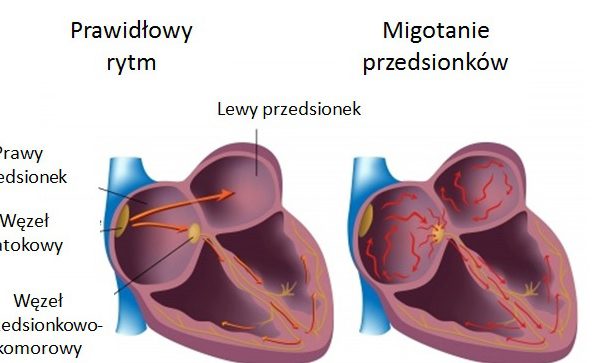 migotanie przedsionkow