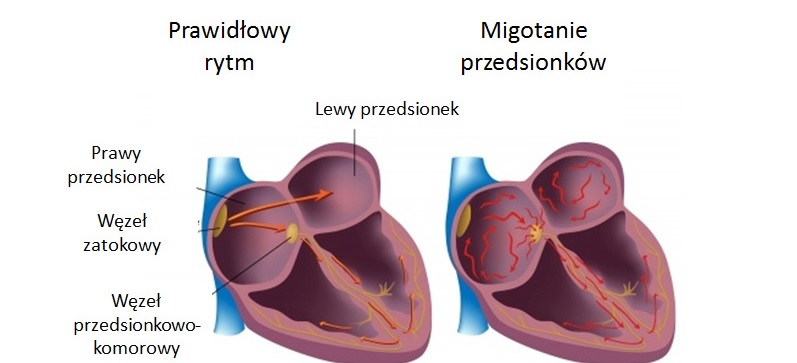 migotanie przedsionkow