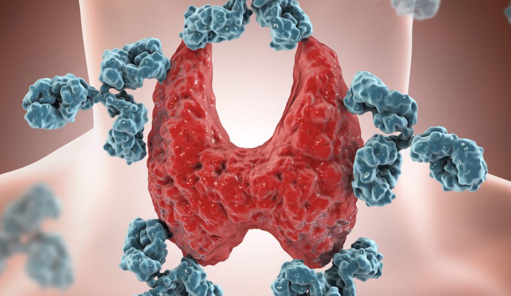 Przeciwciała tarczycy - leczenie